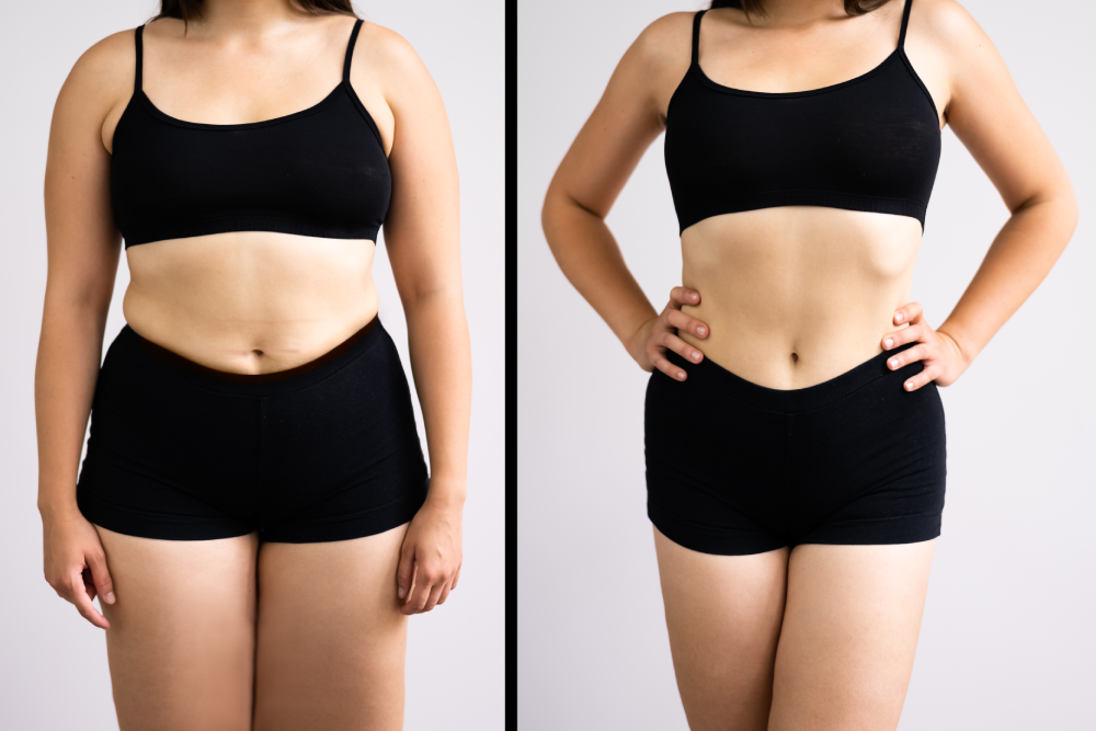 EMSculpt NEO before and after results on a woman’s body.