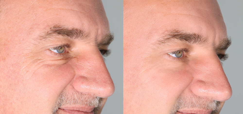 Man's face showing before and after Botox results.