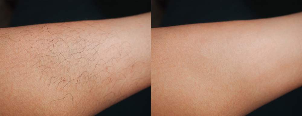 Laser hair removal before and after on arm.