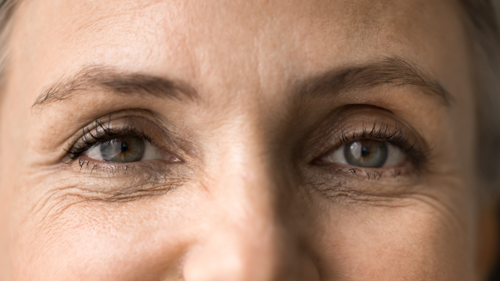 Close-up of a woman's eyes with fine lines ideal for Botox.