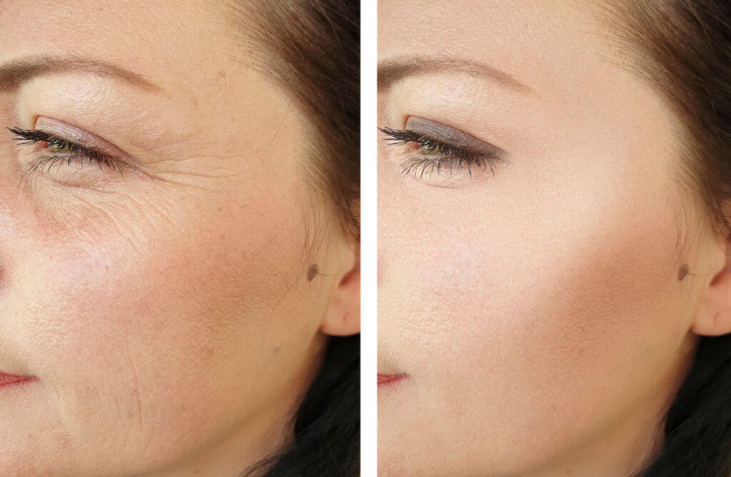 Microneedling before and after results showing smoother skin.