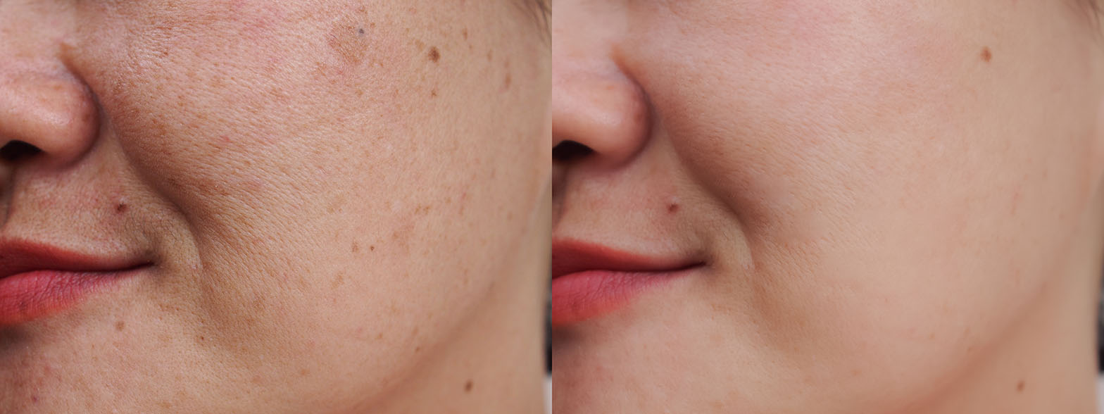 Left and right close-up cheek images showing visible differences in pigmentation, texture, and small dark spots.