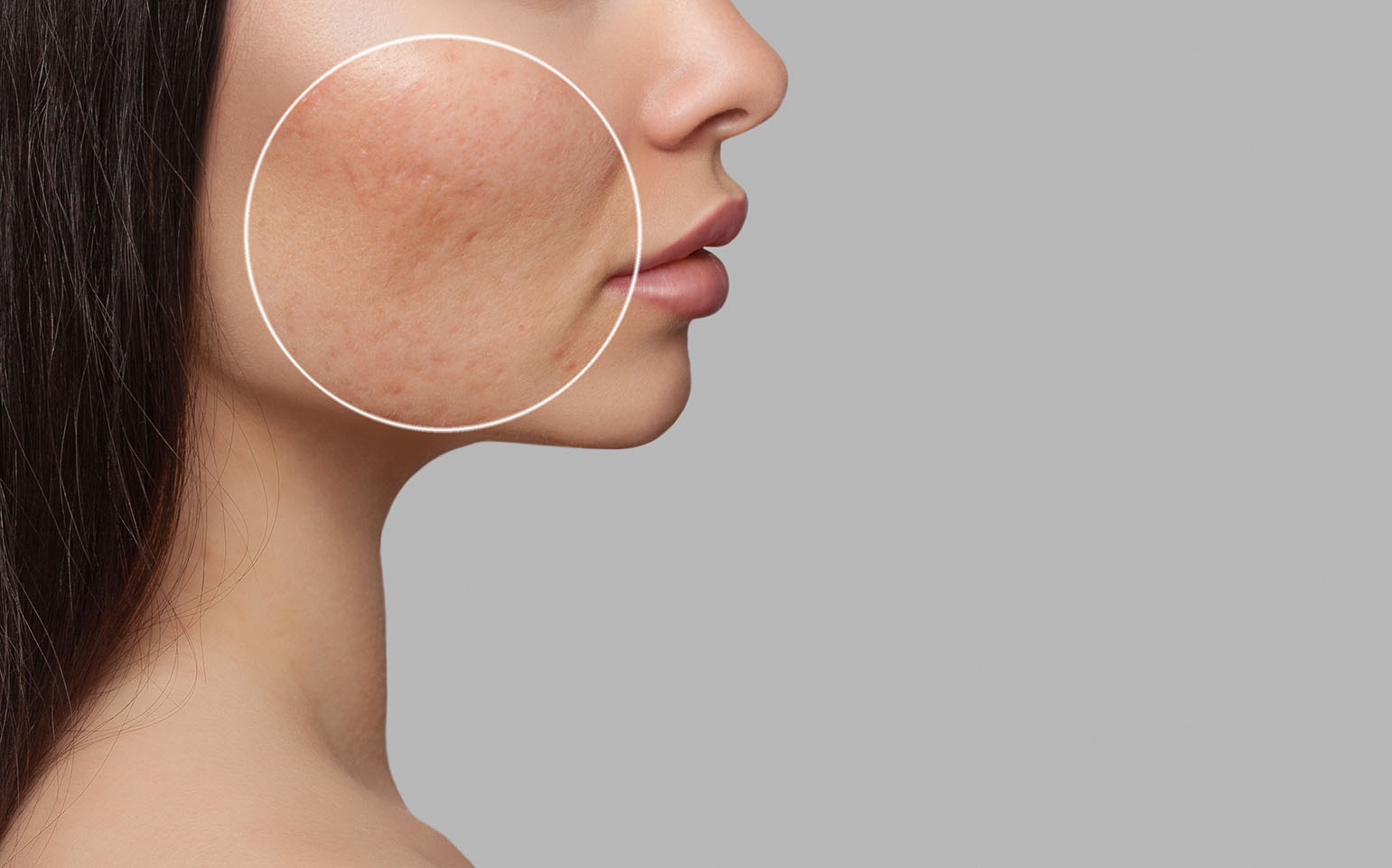 Side view of a woman’s cheek with visible acne scarring highlighted inside a circular overlay.