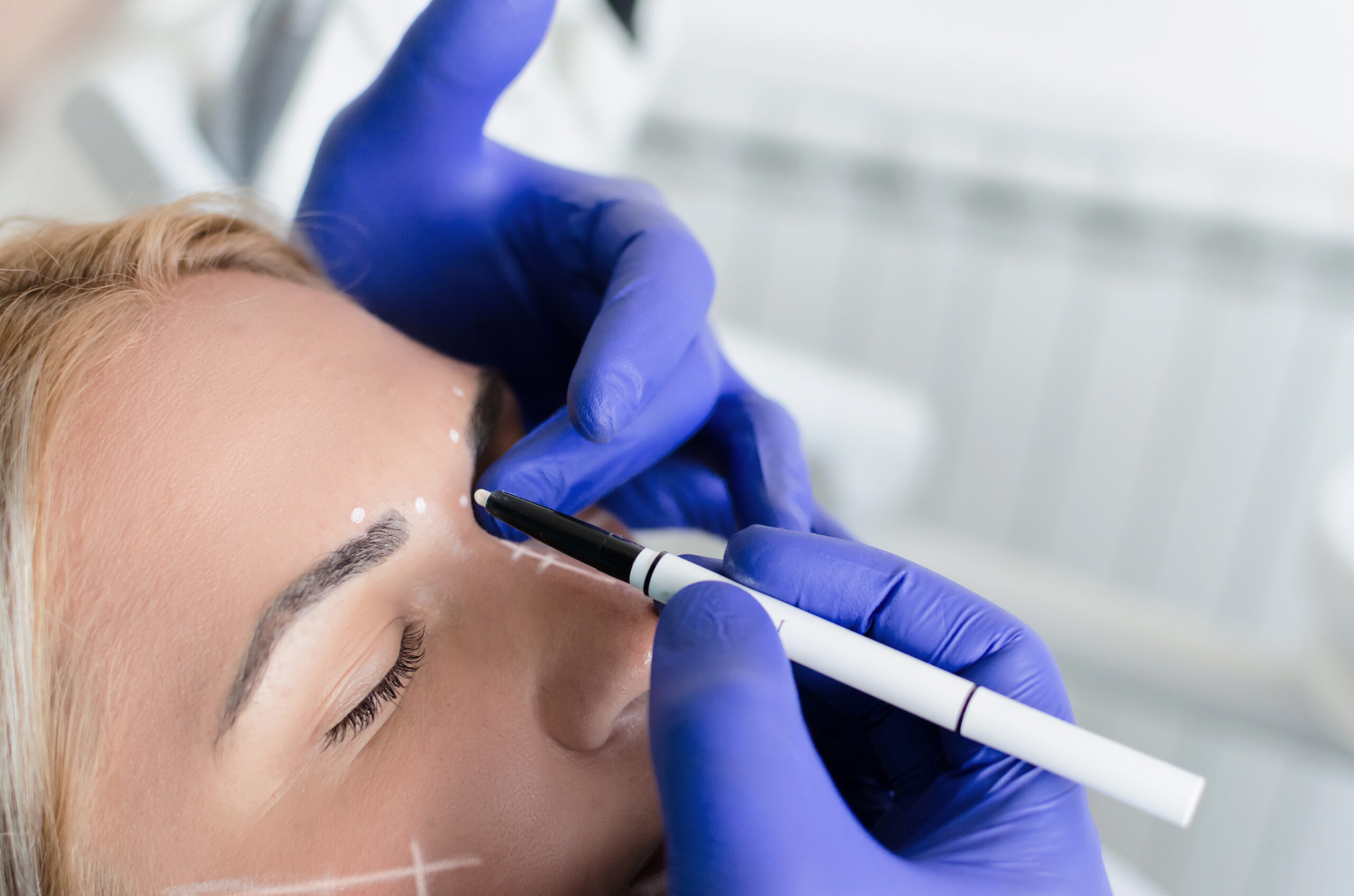 Practitioner in blue gloves marking small injection points on a woman’s forehead before treatment.