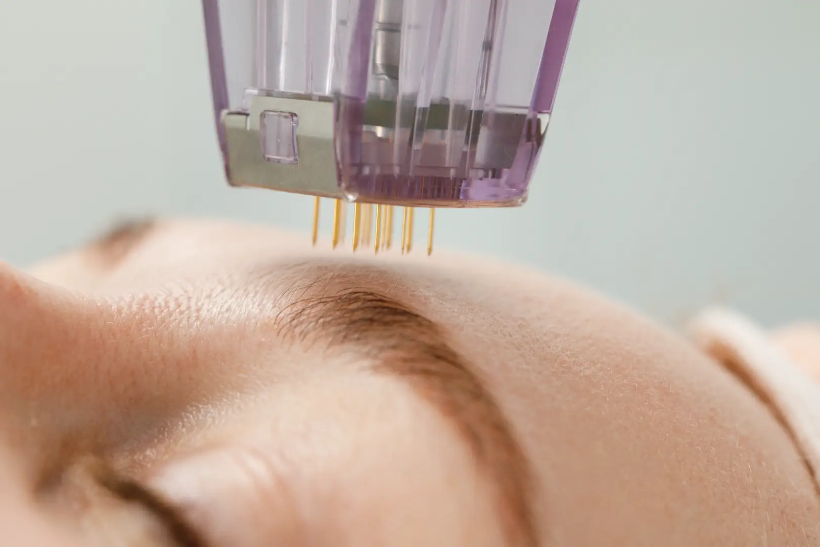 Close-up of a microneedling device with multiple fine needles positioned above a person's forehead.
