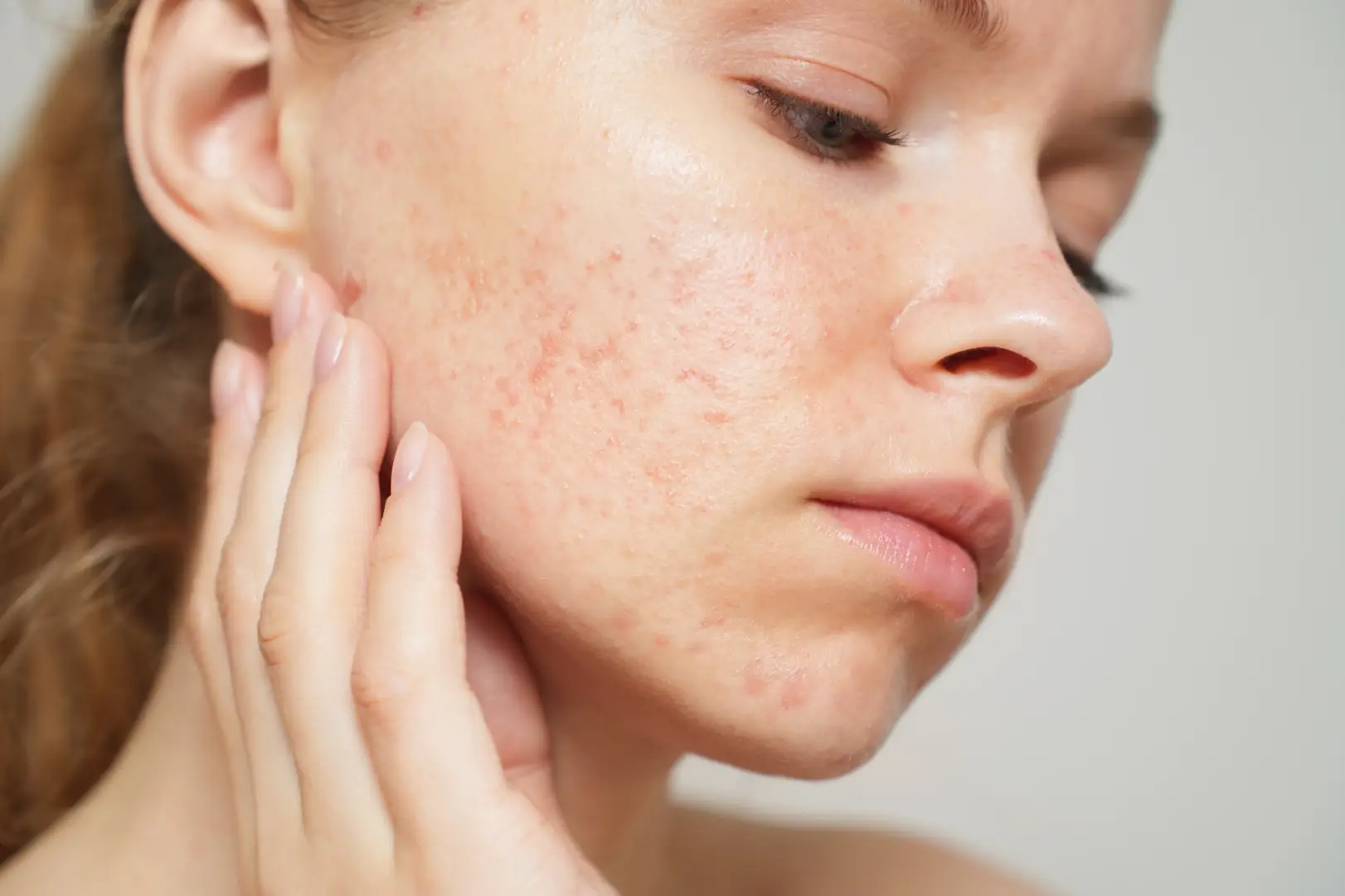 Close-up of a woman touching her cheek with visible redness, small bumps, and uneven skin texture.